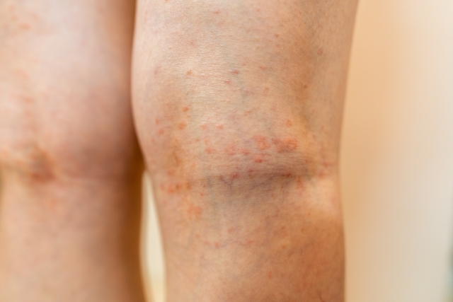 まさか帯状疱疹？ひざ裏に広がった赤い発疹の衝撃の理由